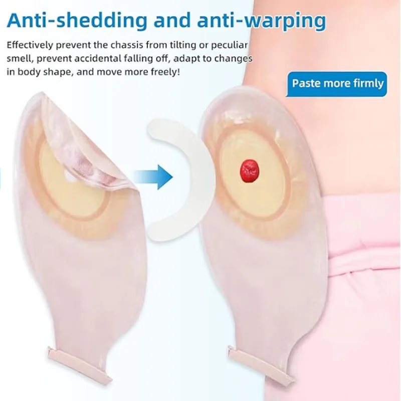 Medical Tape - แถบเสริมความแข็งแรงสำหรับถุงออสโตมีทางการแพทย์ เทปยืดหยุ่นแบบไวต่อแรงกด เทปสปันเลซ แถบปิดผนึกขอบกาว แถบต่อขยาย